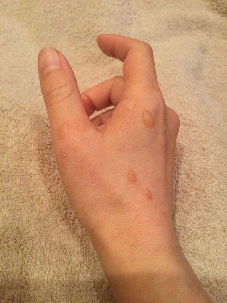 火ぶくれができた