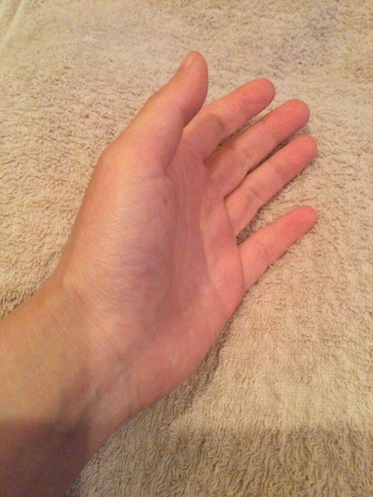 ちょうどほくろの斜め下あたりに、1.5〜2cm大のやけどをした。